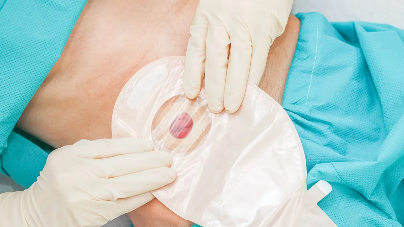 Stomathérapie à domicile Genève - Matériel stomie